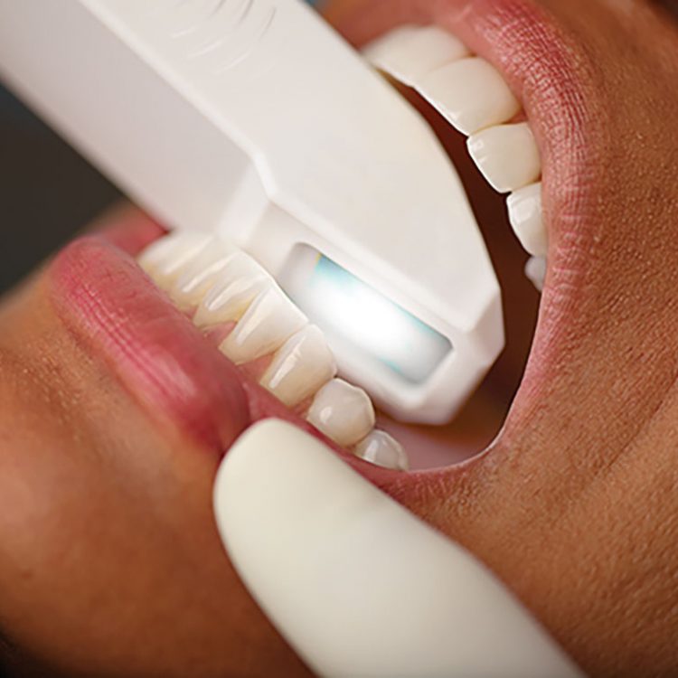 digtal teeth scanner