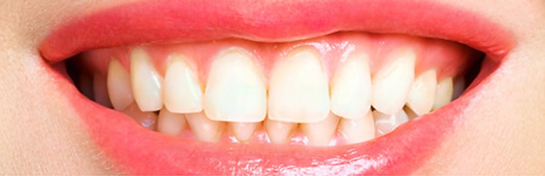 teeth-whitening before