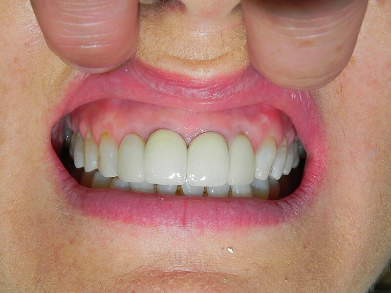 Cosmetic Implants After