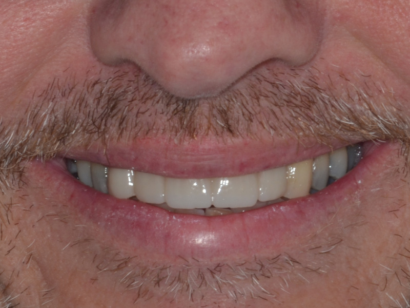 Cosmetic Implants Replace Missing Teeth After