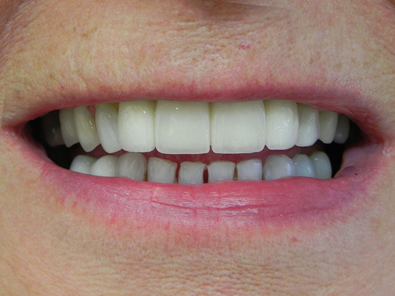 Trauma Cosmetic Dentistry Implants Crowns After