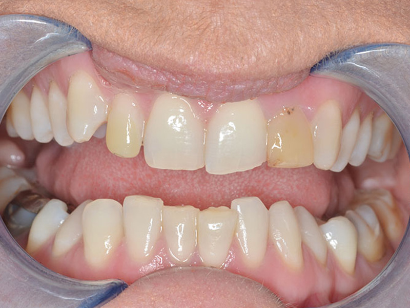 Cosmetic Crowns to fix Discolouration Before
