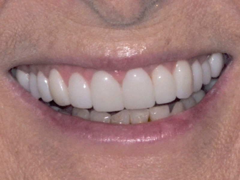 Cosmetic Gum Lift Crowns After
