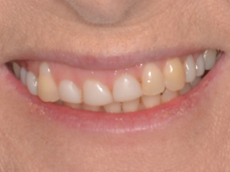 Cosmetic Gum Lift Crowns Before