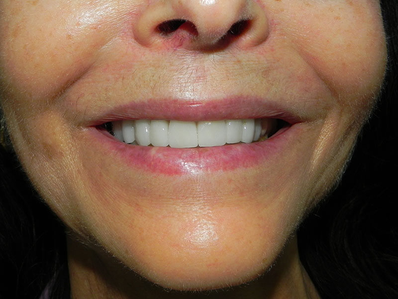 Crowns Cosmetic Dentistry After