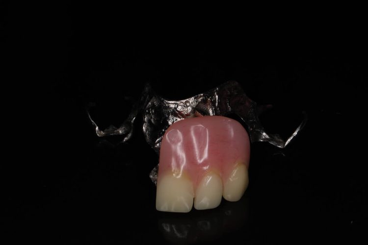 Upper Chrome Denture
