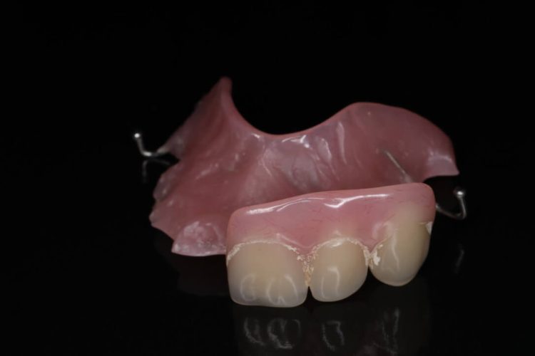Upper Acrylic Dentures