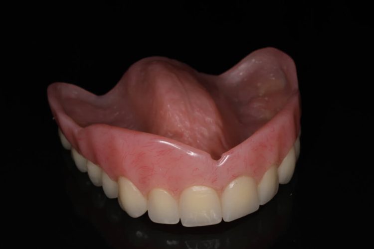 Full Upper Denture